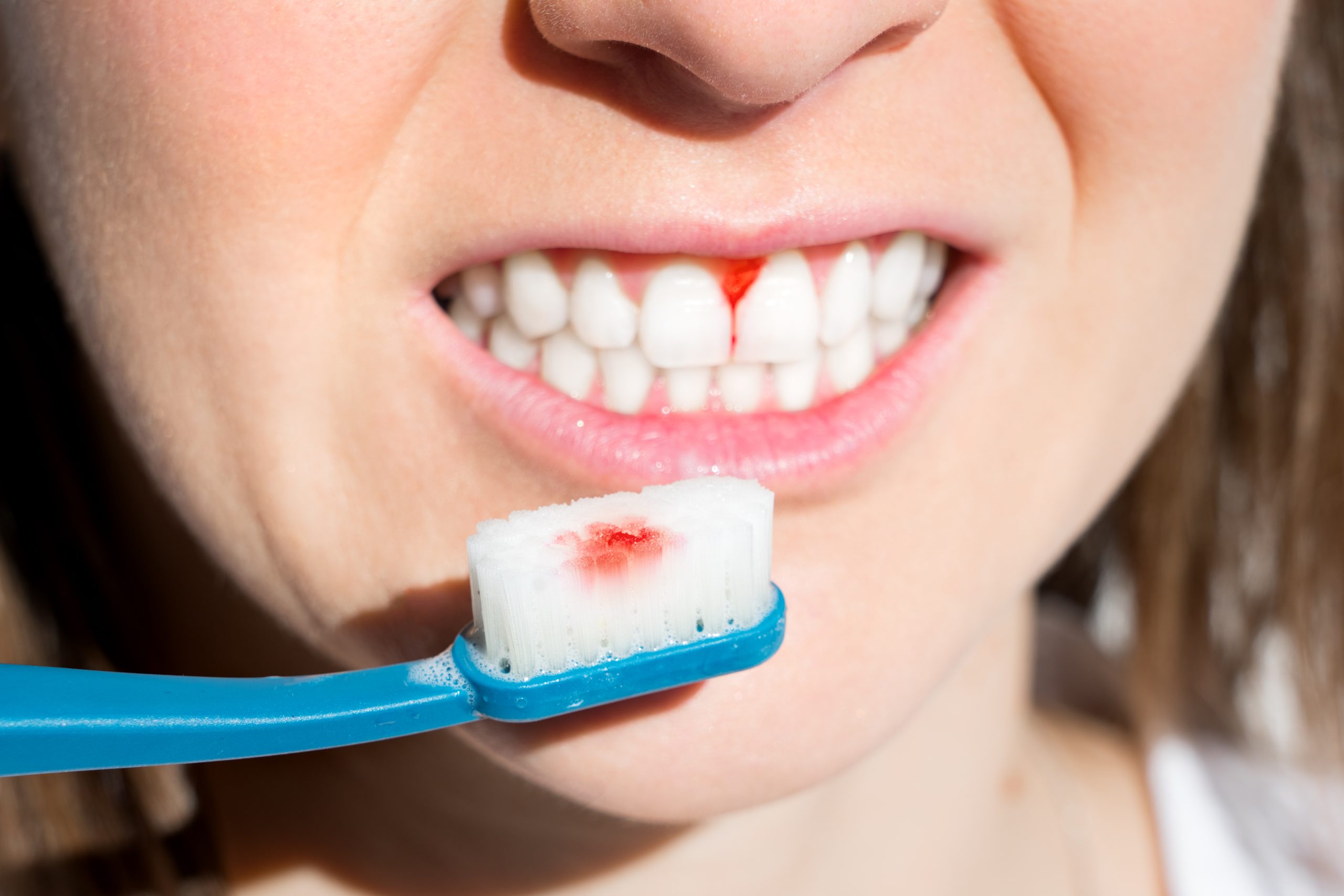 Una mujer con las encías rojas y sangrando sujeta un cepillo de dientes azul con sangre en las cerdas